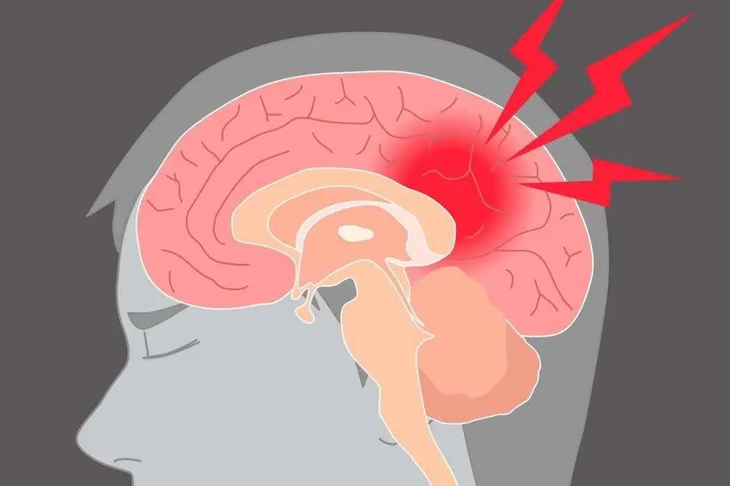 预防脑梗从习惯做起,这三大坏习惯,有的赶紧改正! 预防脑梗从习惯做起,这三大坏习惯,有的赶紧改正!